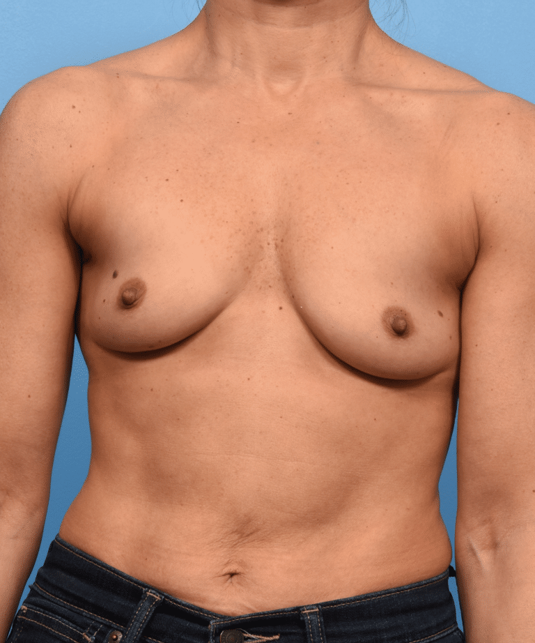 Before Image: Breast Augmentation with Preservé™ Technique - front