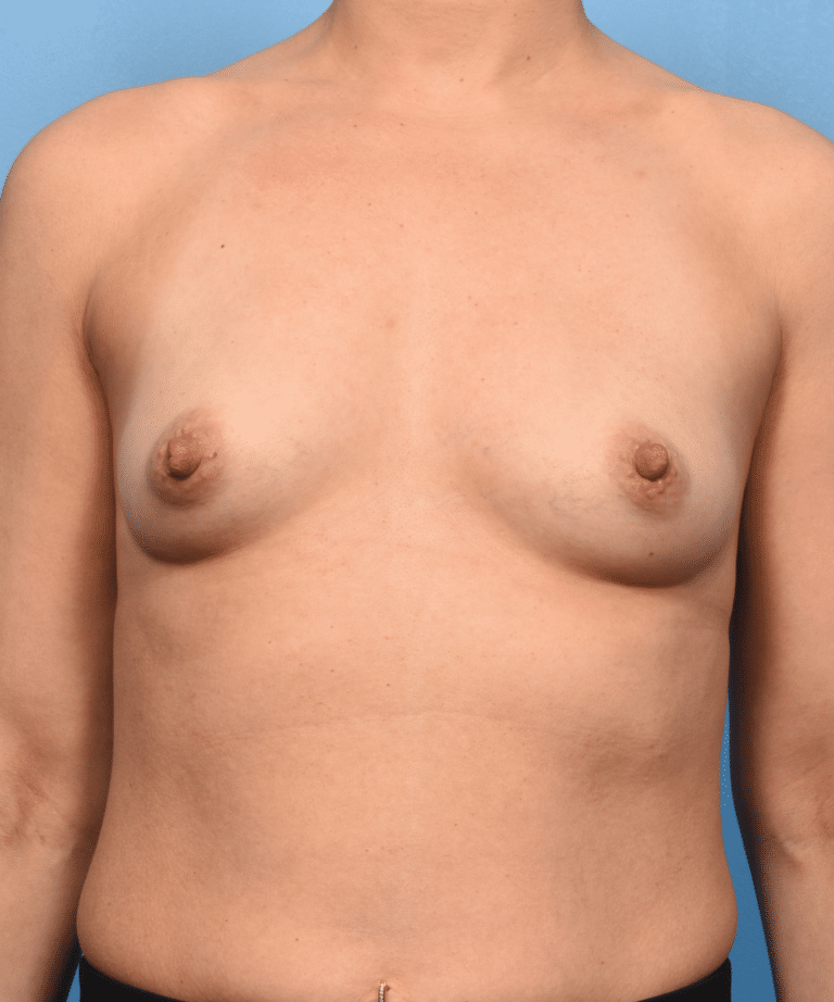 Before Image: Breast Augmentation with Preservé™ Technique - front