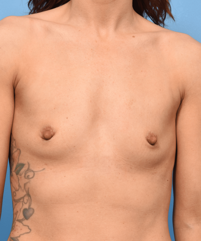 Before Image: Breast Augmentation with Preservé™ Technique - front