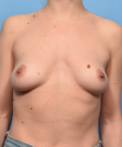 Breast Augmentation with Preservé™ Technique