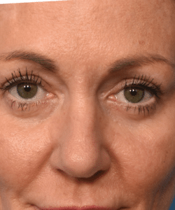 Blepharoplasty