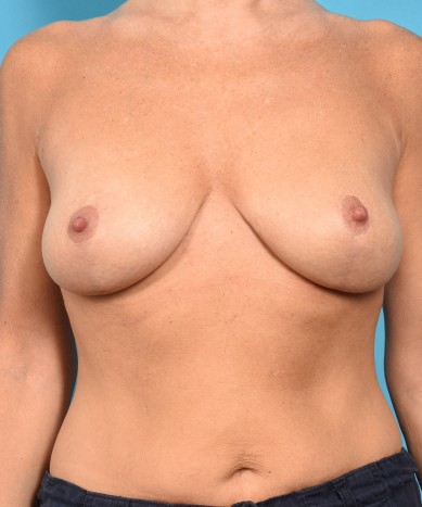 Breast Lift (Mastopexy) with Seri surgical scaffolding