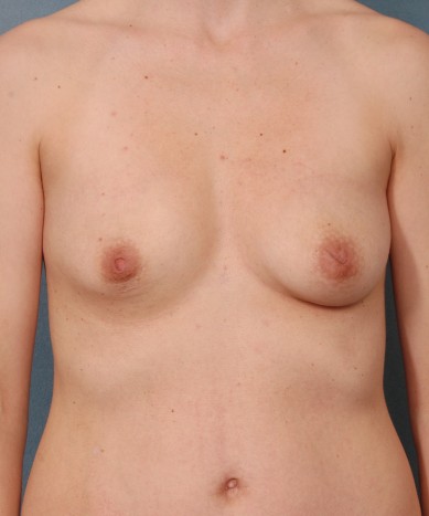 Breast augmentation with severely asymmetric breasts