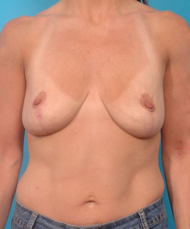 Breast reduction – Female (“Lollipop technique”)