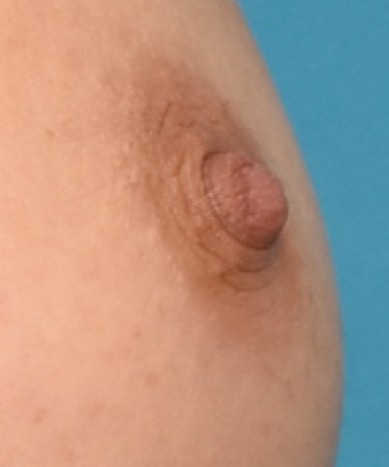 Correction of inverted nipples