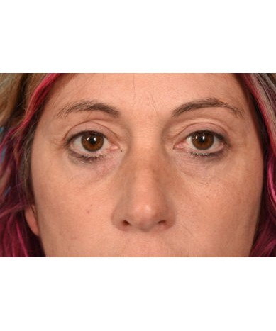 Blepharoplasty followed by ThermiSmooth
