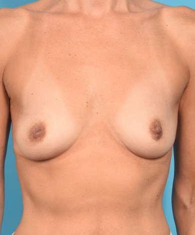 Breast Enhancement with silicone – Allergan 410 “Gummy Bear” implants