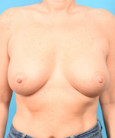 Breast Augmentation – Allergan 410 Gummy Bear