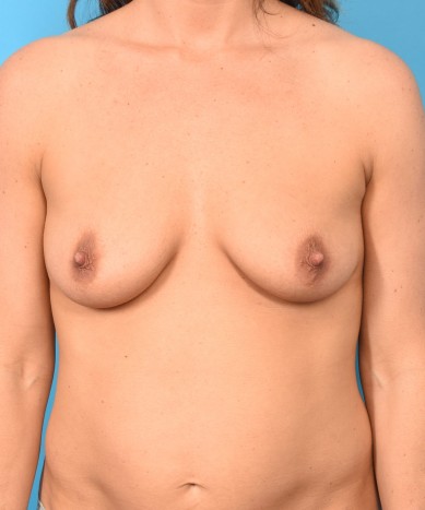 Breast Augmentation with Silicone Round Gummy Implants