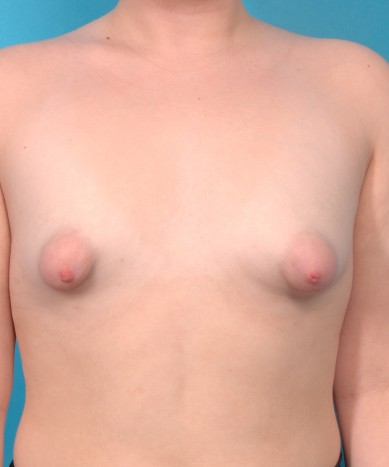 Before Image: Breast Augmentation – Allergan 410 Gummy Bear Implants: Asymmetry And Tubular Breast Deformity - front