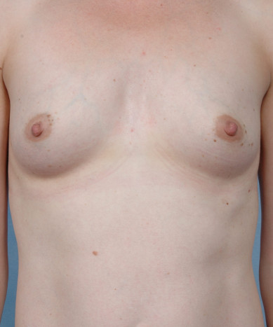 Breast Augmentation – Silicone Round “Non-Gummy” Implants