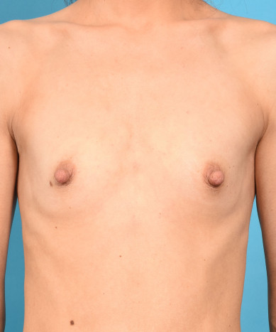 Breast Augmentation – Silicone Allergan 410 teardrop