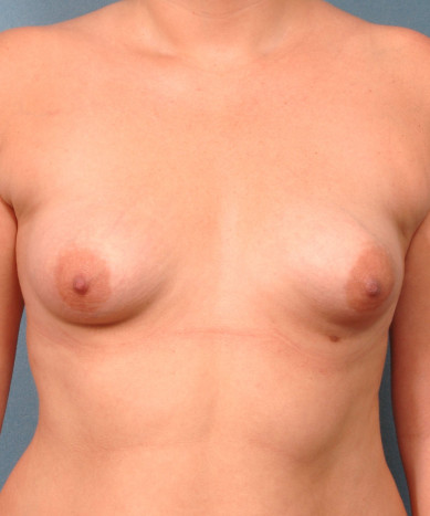 Correction of Tubular Breasts