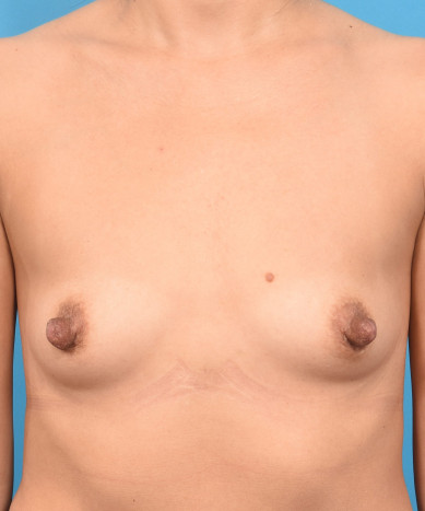 Breast Augmentation – Silicone Round “Gummy Bear” Implant