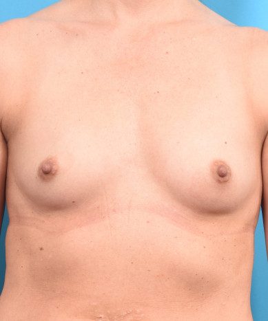 Breast Augmentation – Silicone Round “Gummy” Implant