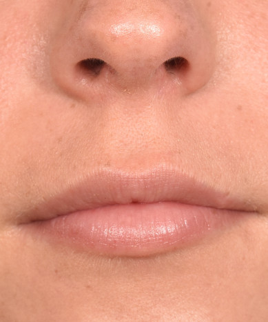 Juvederm