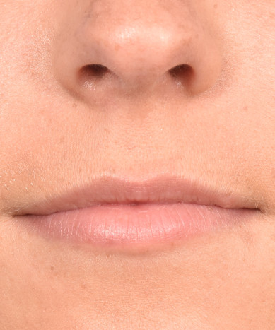 Juvederm