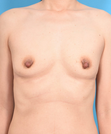 Breast Enhancement With Silicone – Allergan 410 Teardrop Shaped “Gummy Bear” Implants