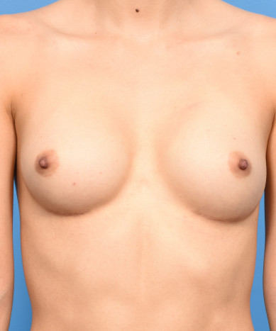 Breast Augmentation – Silicone 410 Teardrop Shaped “Gummy Bear” Implant