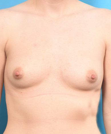 Breast Augmentation – Silicone Round “Gummy” Implants