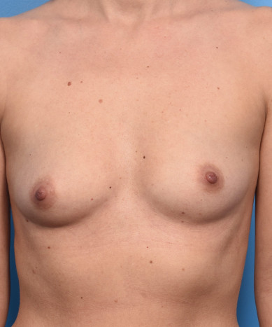 Breast Enhancement With Silicone Round “Gummy” Implants