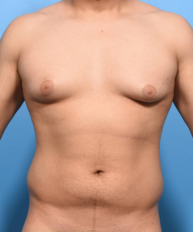 Before Image: VASER 4D Lipo of the Abdomen, Flanks and Chest with Bodytite - front