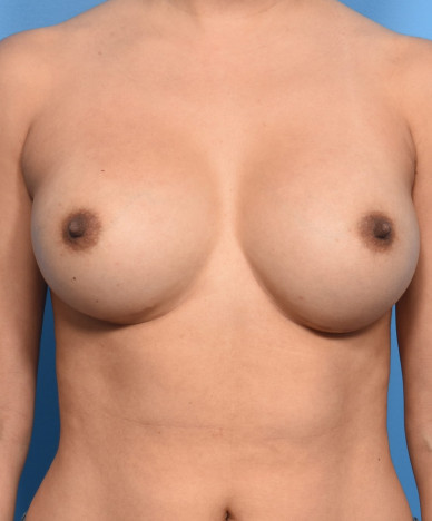 Breast Augmentation – Silicone Round Non-Gummy