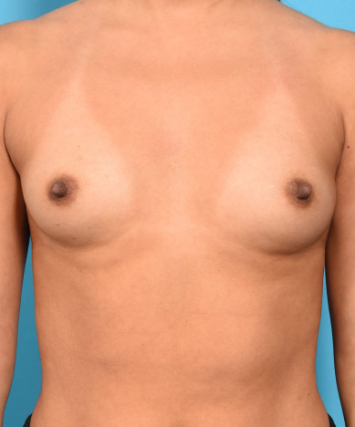 Breast Augmentation – Silicone Round Non-Gummy