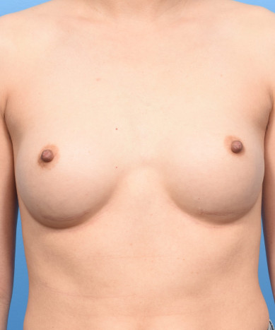 Breast Enhancement With Silicone Round “Gummy” Implants