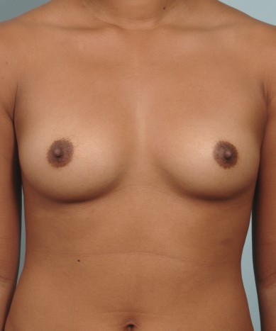 Before Image: Breast Augmentation – Silicone - front