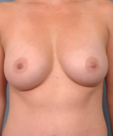 Breast Enhancement with Silicone – Allergan 410 “Gummy Bear” Implants