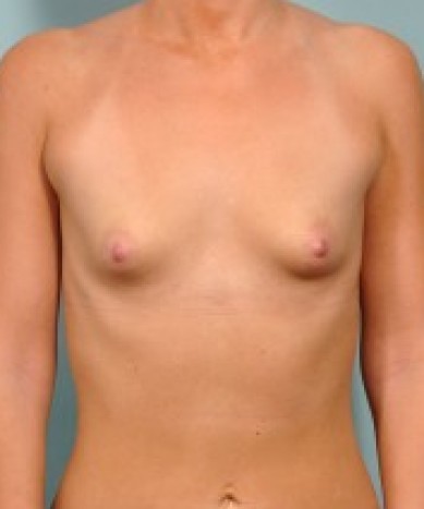 Before Image: Breast Augmentation with Anatomic Silicone Implants - front