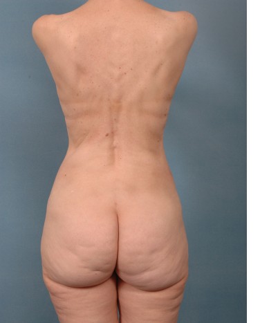VASER liposuction of outer thighs, flanks and fat transfer to buttocks and hips
