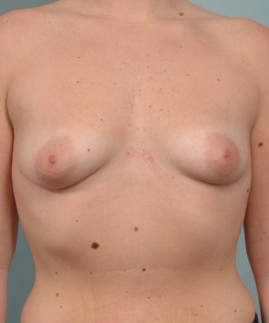 Before Image: Breast enhancement with silicone round implants - front