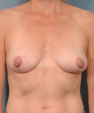 Breast reduction – Female (“lollipop technique”)