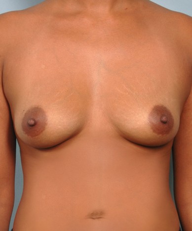 Breast Enhancement with silicone – Allergan 410 “Gummy Bear” implants