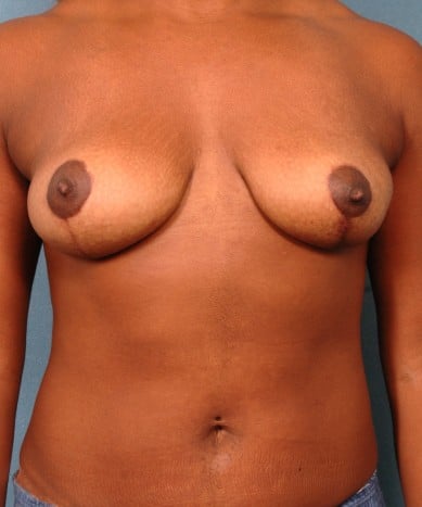 Breast Lift (Mastopexy) with Seri surgical scaffolding