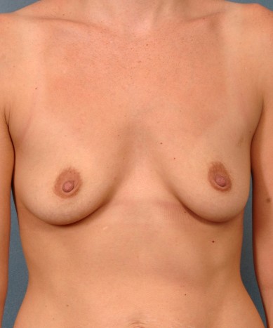 Breast enhancement with round silicone implants