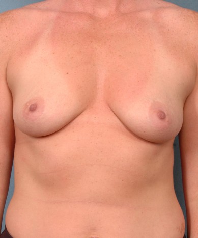 Breast enhancement with silicone – allergan 410 “Gummy bear” implants