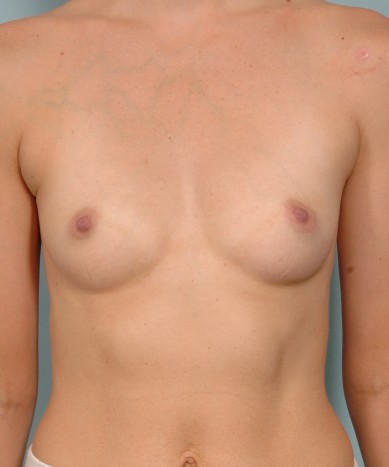 Breast enhancement with silicone – allergan 410 “Gummy bear” implants